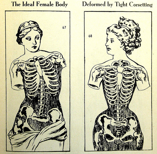 A vintage illustration illustrating a rib cage "deformed by tight corseting."